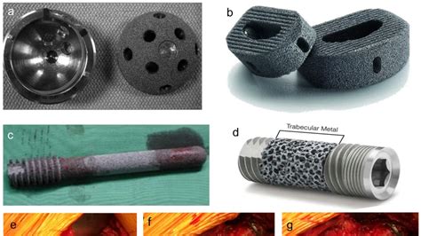 Tantalum: A Biocompatible Champion for Orthopedic and Dental Implants!